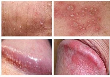 Nhận biết bệnh thế nào qua hình ảnh viêm da bao quy đầu ?