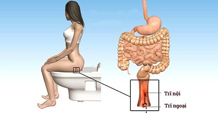 Trĩ nội là gì ? Vì sao phải đi khám trĩ nội ?