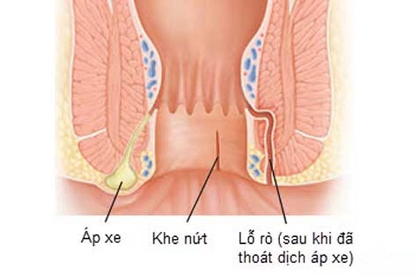 Áp xe cạnh hậu môn là gì?