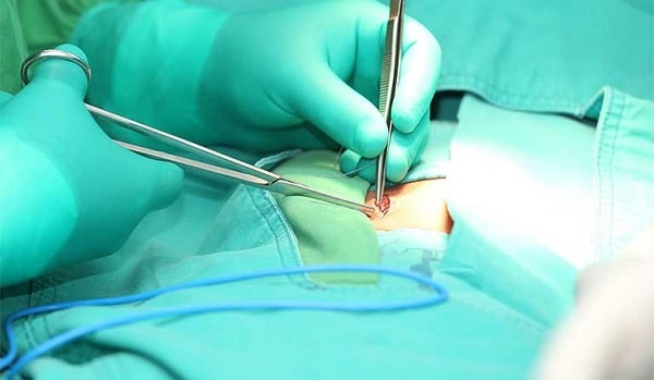 Tìm hiểu về quy trình mổ áp xe hậu môn