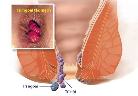 Mổ trĩ ngoại tắc mạch như thế nào ?