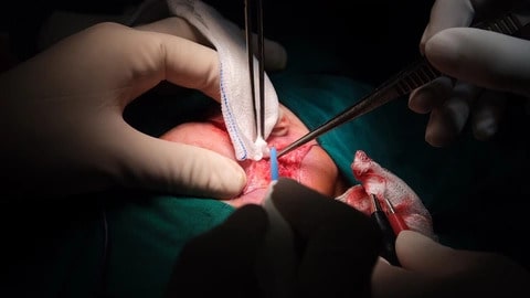 Tiến hành một số tiểu phẫu tại hậu môn trực tràng