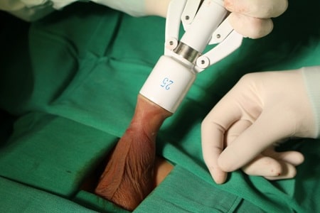 Cách điều trị viêm bao quy đầu bằng tiểu phẫu cắt bao quy đầu