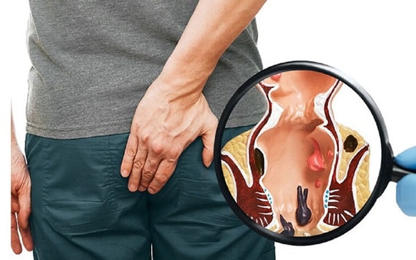 Khi nào cần đi khám áp xe hậu môn?