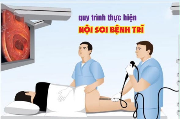 Bạn đã biết rõ về quy trình thực hiện nội soi trĩ?