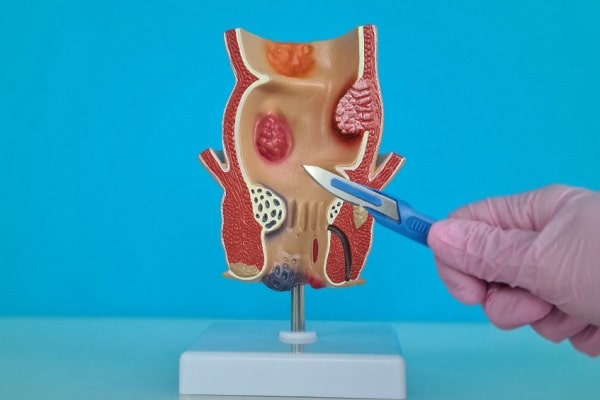 Phẫu thuật rò hậu môn vì sao nên thực hiện ngay từ sớm?