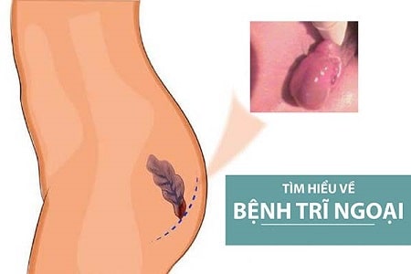 Bệnh trĩ ngoại là gì ?