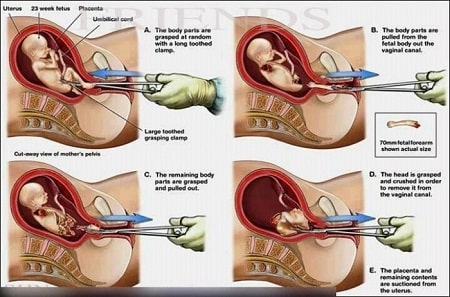Quy trình nạo phá thai sẽ thực hiện thế nào?