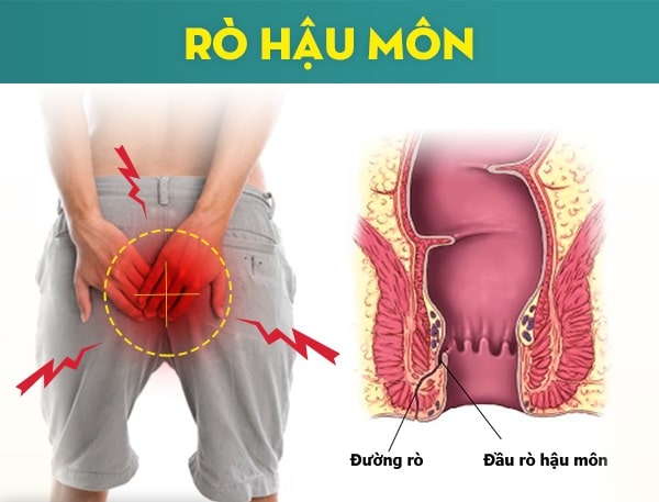 Rò hậu môn – Căn bệnh “rò rỉ” sức khỏe thầm lặng nhưng vô cùng dai dẳng