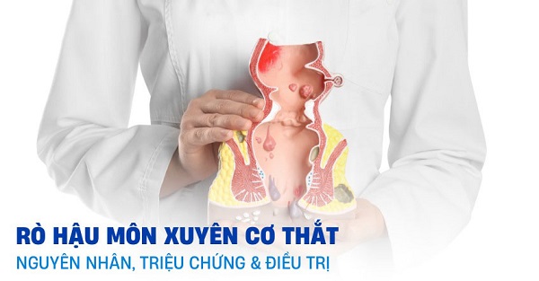 Nhận diện những dấu hiệu điển hình khi bị rò hậu môn xuyên cơ thắt