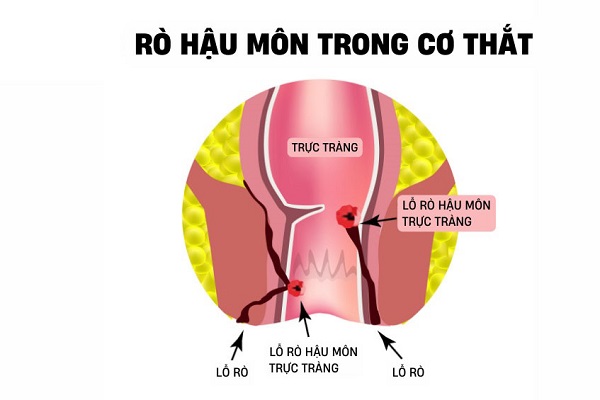 Thế nào là rò hậu môn xuyên cơ thắt ?