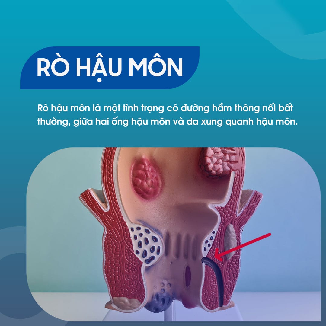 Rò lỗ hậu môn là gì? Làm sao để biết mình mắc bệnh?