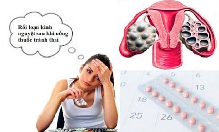 Bị rối loạn kinh nguyệt sau khi uống thuốc tránh thai phải làm sao ?