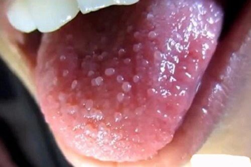 Cuống lưỡi nổi nhiều hạt