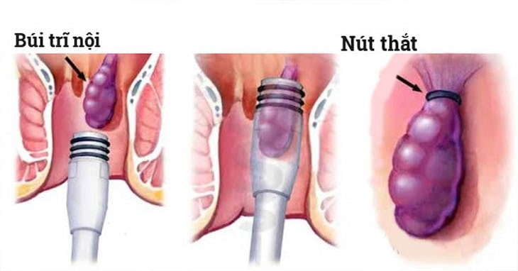 Thắt trĩ ngoại là gì, quy trình thực hiện ra sao ?