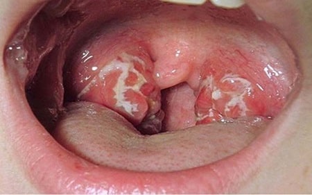 Triệu chứng xuất hiện sau thời gian ủ bệnh lậu ở miệng là gì?