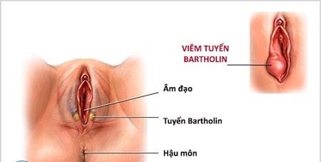 Tại sao phải điều trị viêm tuyến Bartholin ?