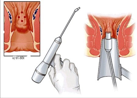 Tiêm xơ trĩ liệu có phải phương pháp khả thi?