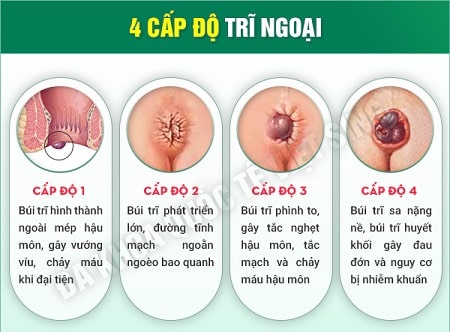 Trĩ ngoại có nguy hiểm không?