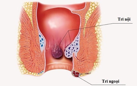 Phổ cập thông tin tổng quan về bệnh trĩ ngoại