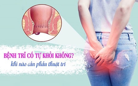 Trĩ ngoại có tự khỏi được không ? 