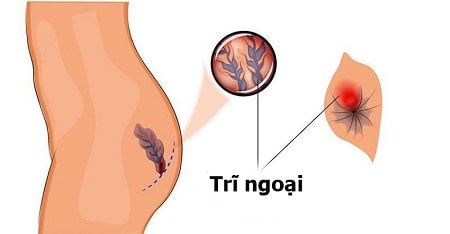 Cập nhật chi tiết về bệnh trĩ ngoại