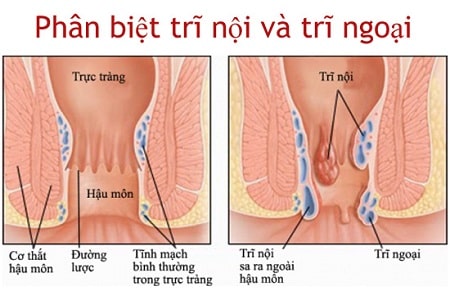 Phân biệt trĩ ngoại và trĩ nội thông qua biểu hiện của từng giai đoạn bệnh