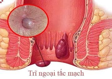 Trĩ ngoại tắc mạch là gì ? Do đâu mà hình thành?