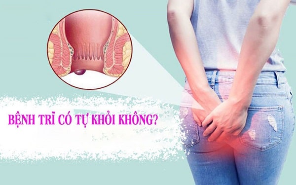 Trĩ nội độ 1 không cần chữa cũng tự khỏi?