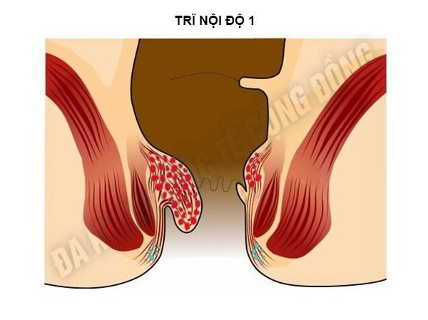 Bệnh trĩ nội độ 1 nên hiểu sao cho đúng?