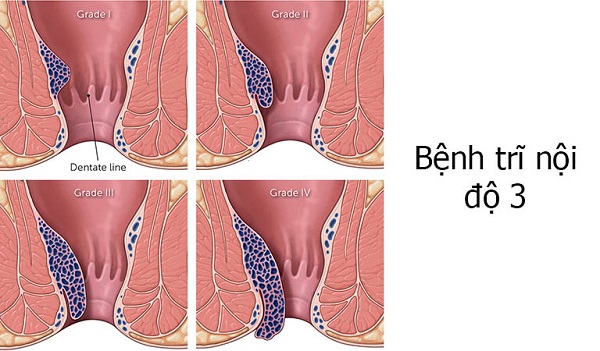 Trĩ nội độ 3 là như thế nào ?
