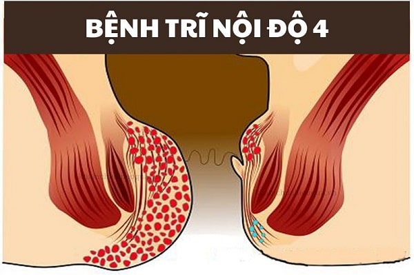 Trĩ nội độ 4 là gì ?