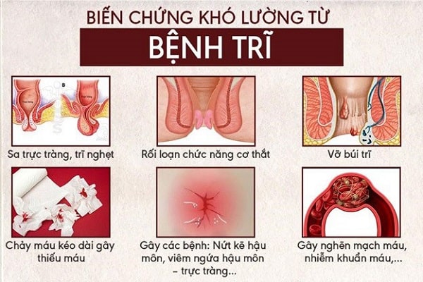 Trĩ nội và trĩ ngoại cái nào nguy hiểm hơn? 