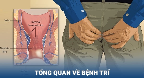 Tổng quan bệnh trĩ là gì ? 