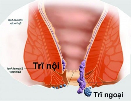 Trĩ nội và trĩ ngoại cái nào nặng hơn  ?