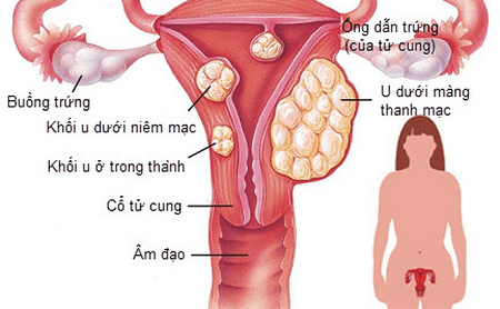 Tìm hiểu nguyên nhân gây u xơ tử cung ở nữ giới