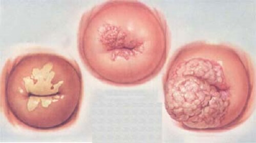 Ung thư cổ tử cung ở nữ giới