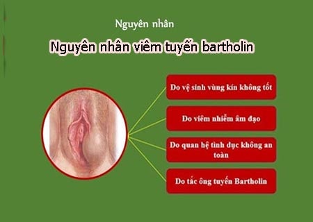 Những nguyên nhân gây ra viêm bartholin thường gặp